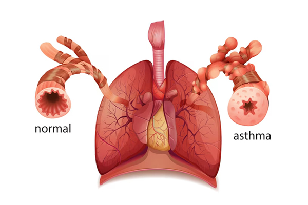Bronchial Asthma